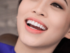 Bọc răng sứ thẩm mỹ