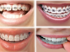 Niềng răng thẩm mỹ