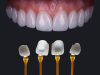 Mặt dán sứ Veneer Emax 