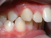 Bọc răng sứ 2 răng cửa hô có được không?