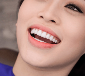 Bọc răng sứ thẩm mỹ