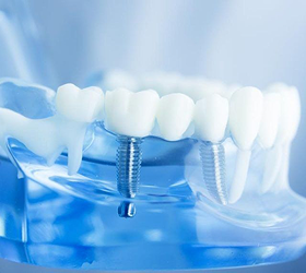 Cấy ghép Implant