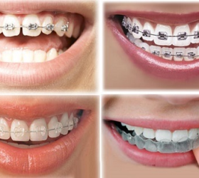 Niềng răng thẩm mỹ