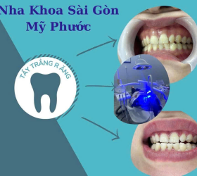 Tẩy trắng răng 