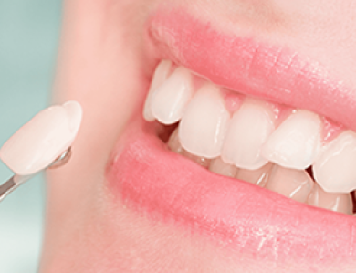 Dán sứ Veneer 