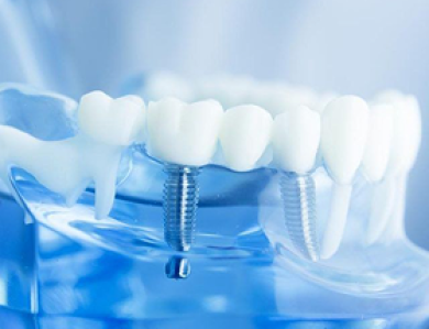 Cấy ghép Implant