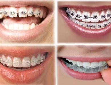 Niềng răng thẩm mỹ