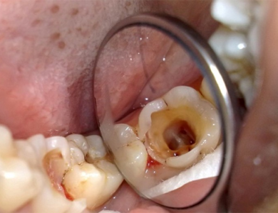 Răng bị sâu lỗ to trám được không? 
