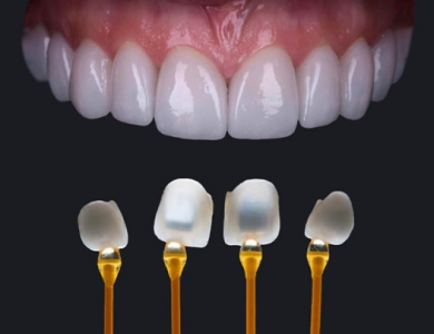 Mặt dán sứ Veneer Emax 
