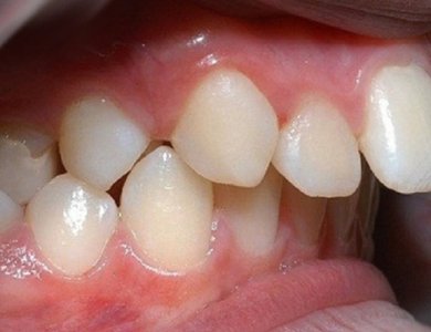 Bọc răng sứ 2 răng cửa hô có được không?