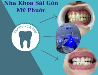 Tẩy trắng răng 