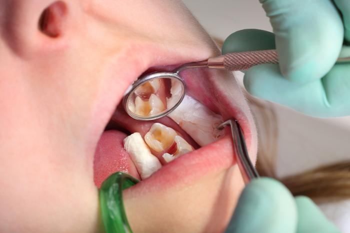 Sâu răng là một trong những yếu tố gây viêm tuỷ răng 