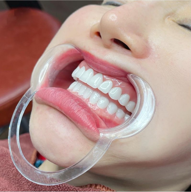 Bọc răng sứ có đau không? Có hại gì không? 
