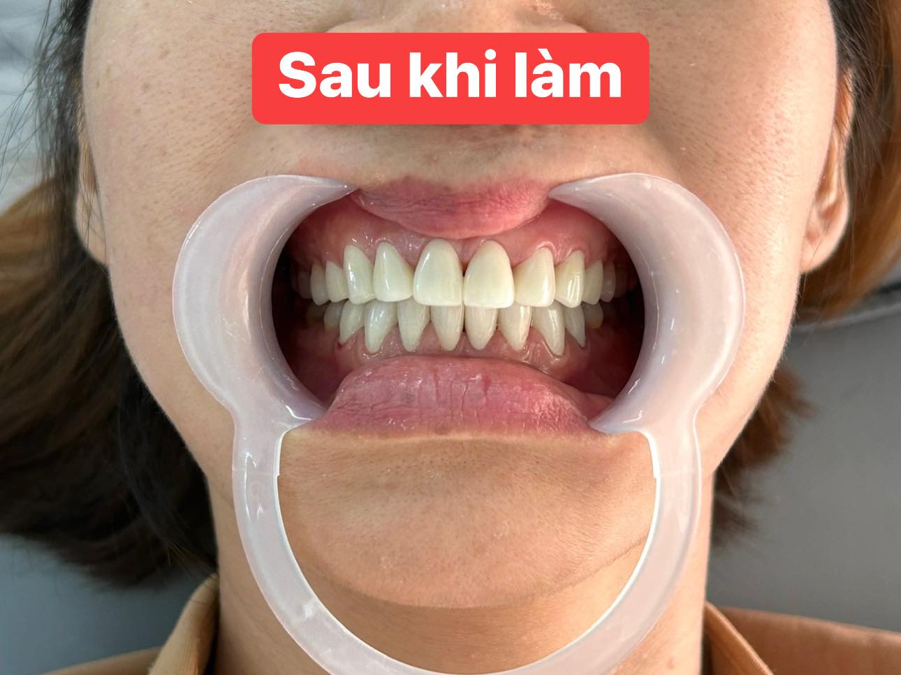 Hình ảnh về khách hàng sau khi làm thẩm mỹ răng sứ bởi Nha khoa uy tín tại Bến Cát, Bình Dương