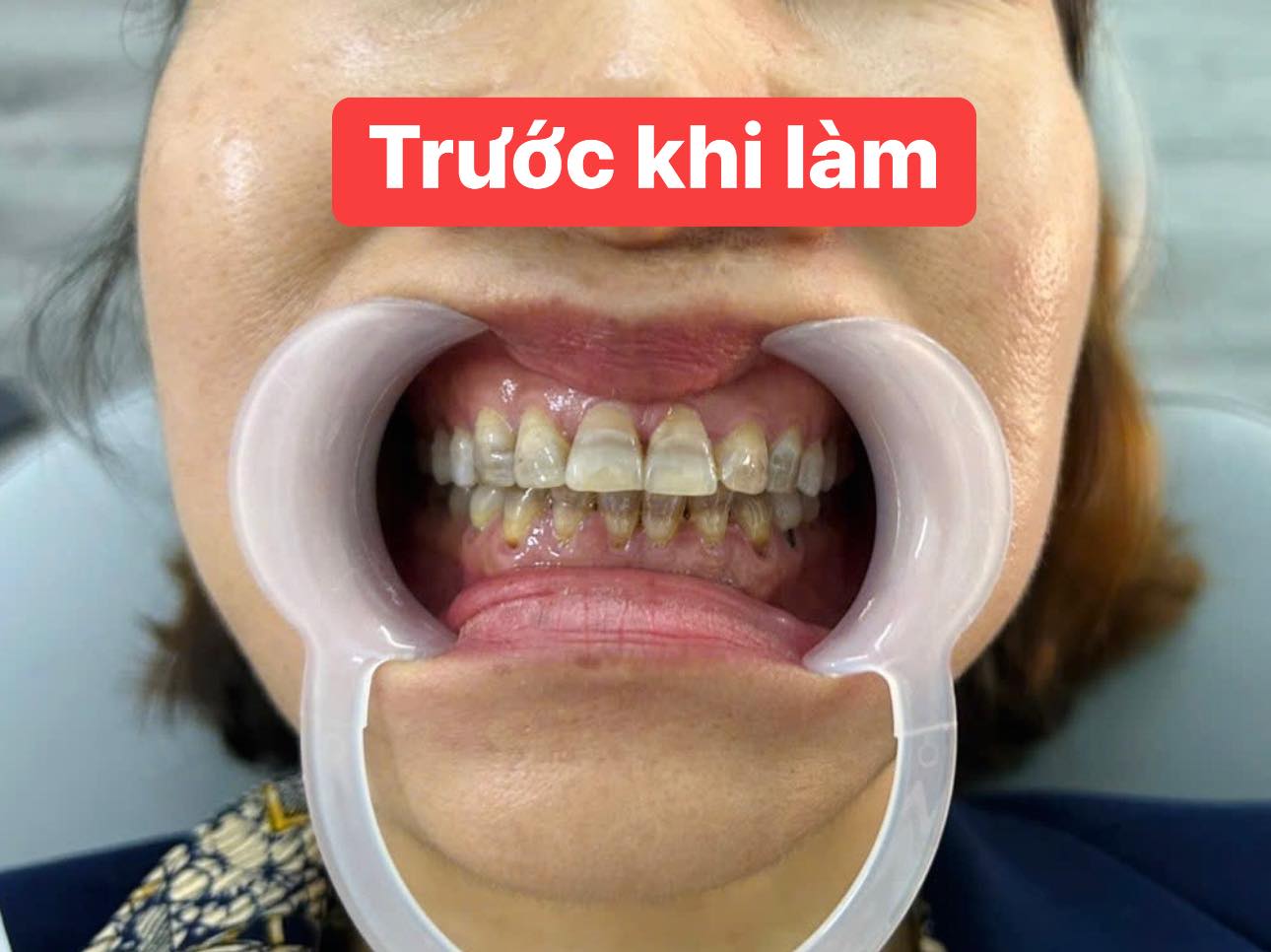Hình ảnh về khách hàng trước khi làm thẩm mỹ răng sứ 