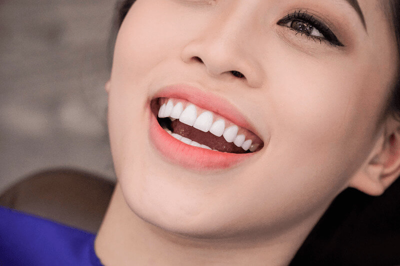 Hình ảnh giới thiệu về bọc răng sứ thẩm mỹ