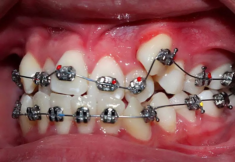 Niềng răng là một trong những dịch vụ nổi bật tại nha khoa Sài Gòn Mỹ Phước: nha khoa uy tín tại Bến Cát, Bình Dương