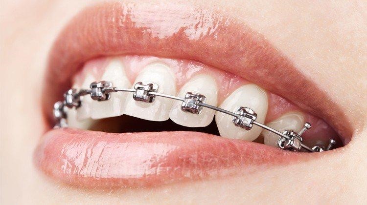 Hình ảnh niềng răng mắc cài kim loại 