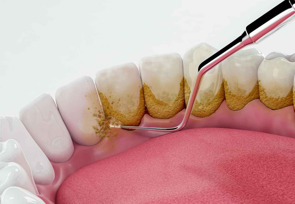 Dịch vụ cạo vôi răng tại nha khoa Sài Gòn Mỹ Phước: nha khoa uy tín tại Bến Cát, Bình Dương