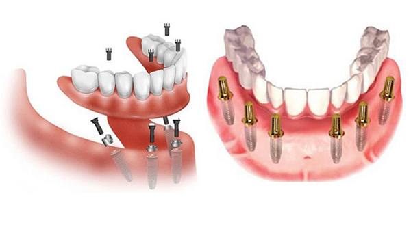 Những trường hợp nên cấy ghép implant