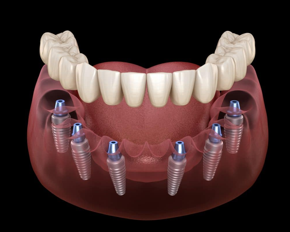 Ưu điểm của cấy ghép implant