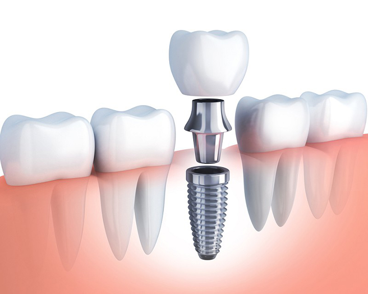 Hình ảnh giới thiệu về cấy ghép implant