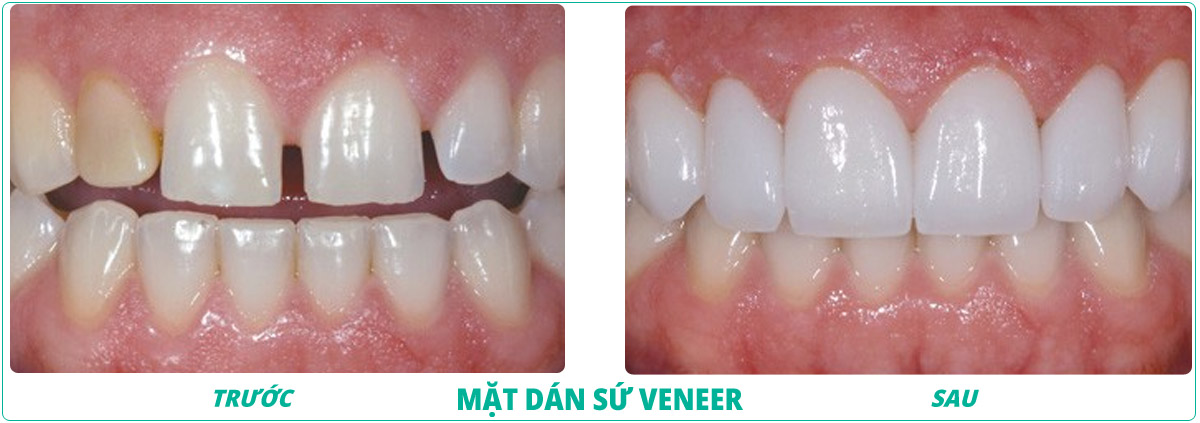 Lợi ích của răng sứ Veneer Emax