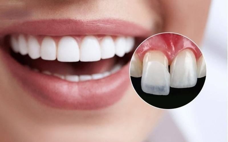 Hình ảnh về mặt dán sứ Veneer