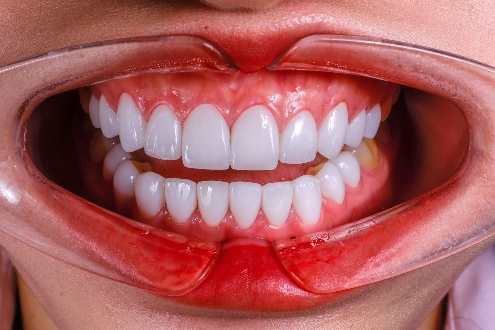 Dán sứ Veneer có tính thẩm mỹ cao, bảo tồn răng thật