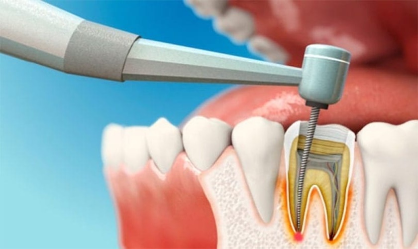 Điều trị tuỷ răng là một quy trình nha khoa nhằm loại bỏ phần tủy răng bị viêm hoặc nhiễm trùng.