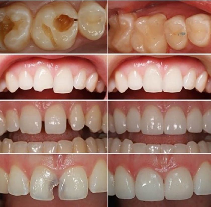 Trường hợp nào có thể trám hàn răng bằng Composite?