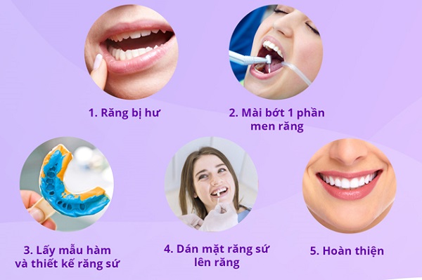 Quy trình làm mặt dán sứ Veneer