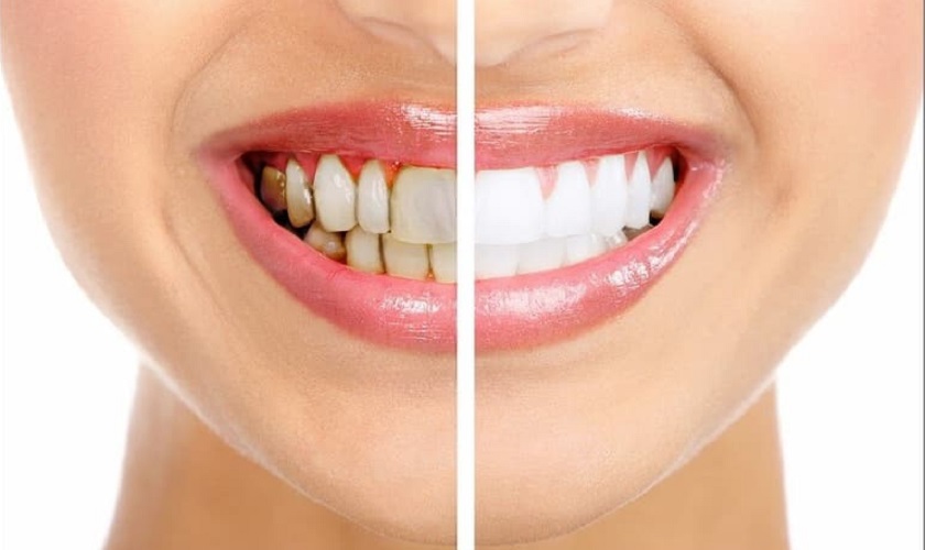 Tuổi thọ của răng sứ