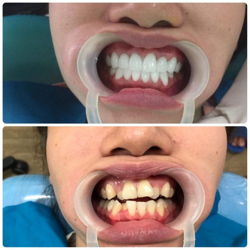Nha khoa Sài Gòn Mỹ Phước có nhiều loại răng sứ cho khách hàng lựa chọn theo nhu cầu