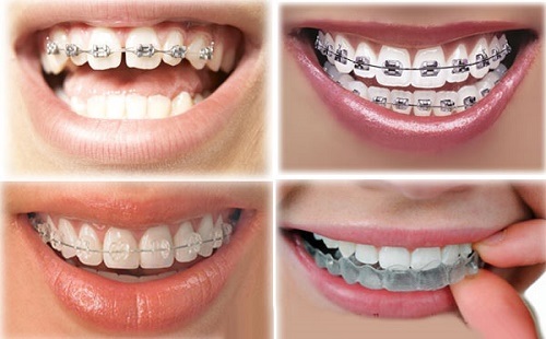 Hình ảnh giới thiệu về niềng răng thẩm mỹ 