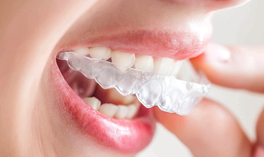 Hình ảnh về Niềng răng Invisalign