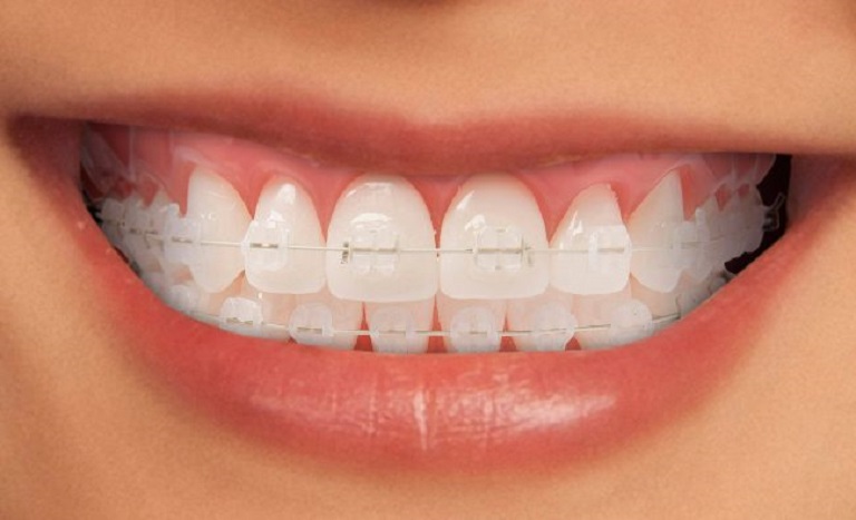 Niềng răng mắc cài sứ 