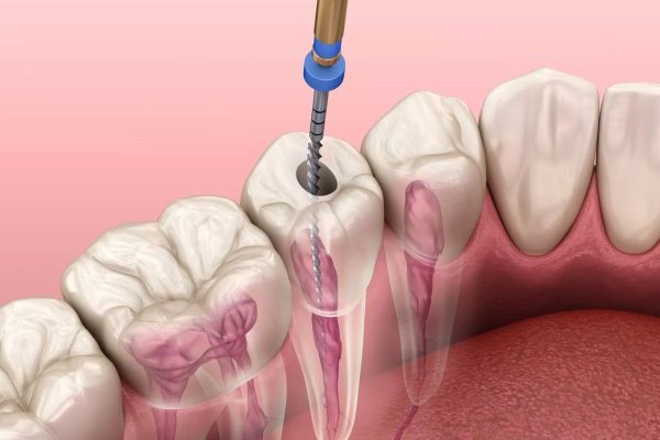 Điều trị tuỷ răng để tránh các viêm nhiễm nặng hơn, ảnh hưởng đến sức khoẻ hằng ngày