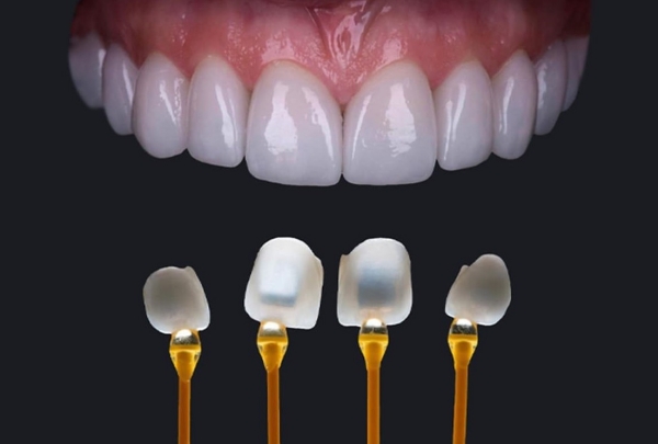 Hình ảnh giới thiệu về mặt dán sứ Veneer Emax