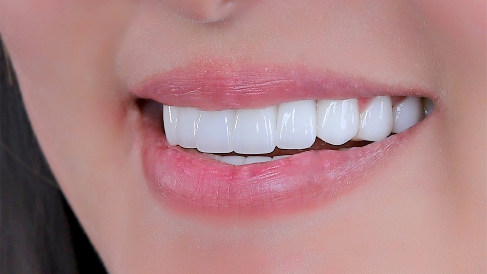 Những ưu điểm vượt trội của bọc răng sứ thẩm mỹ 