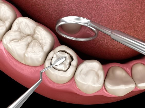 Dịch vụ trám răng tại nha khoa Sài Gòn Mỹ Phước: nha khoa uy tín tại Bến Cát, Bình Dương