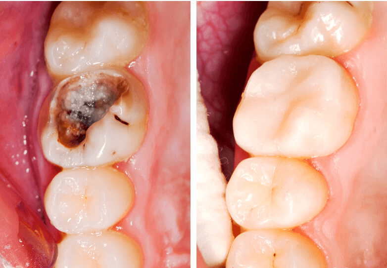 Răng bị sâu lỗ to trám được không? Nha khoa Sài Gòn Mỹ Phước