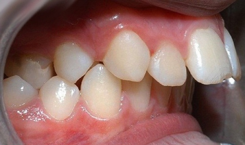 Bọc răng sứ 2 răng cửa hô có được không?