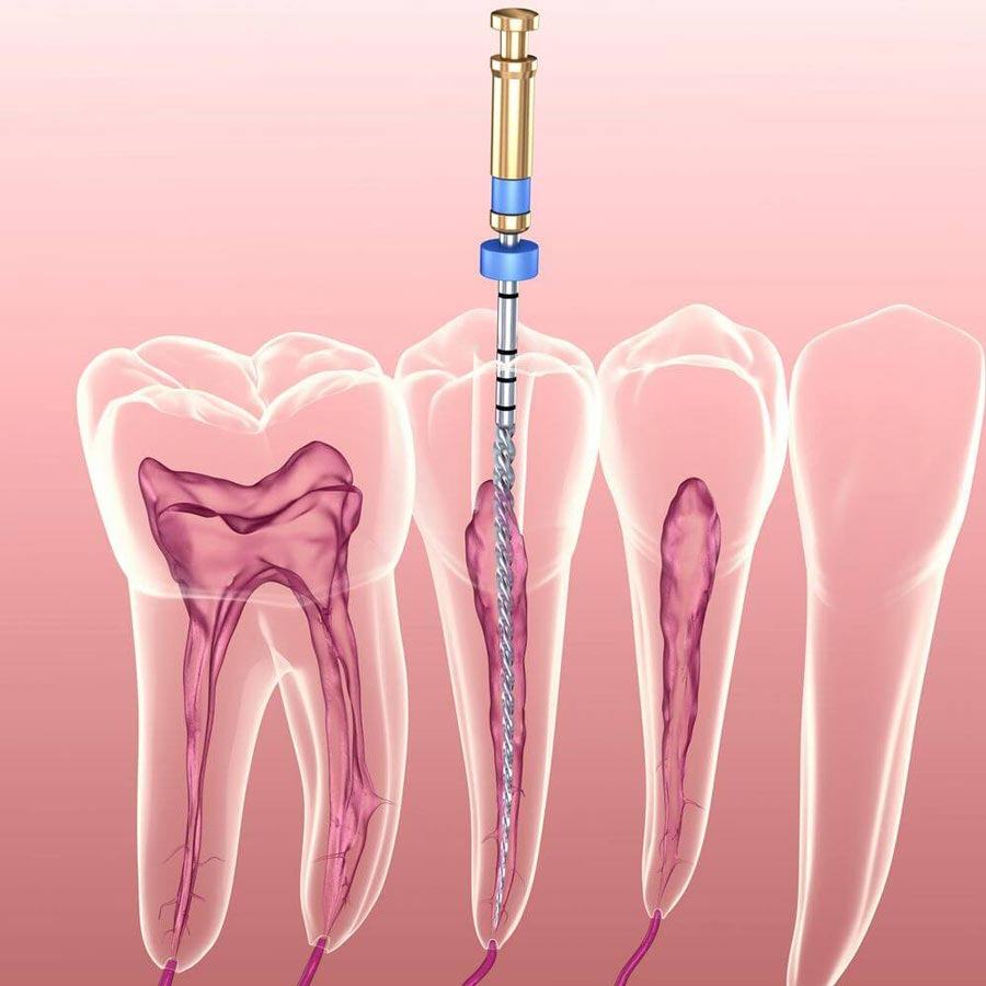Khi nào nên điều trị tuỷ răng