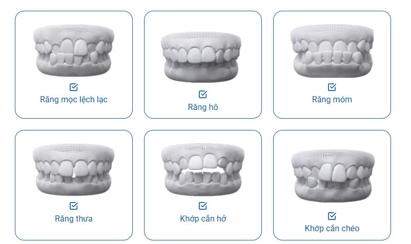 Những trường hợp nên niềng răng thẩm mỹ