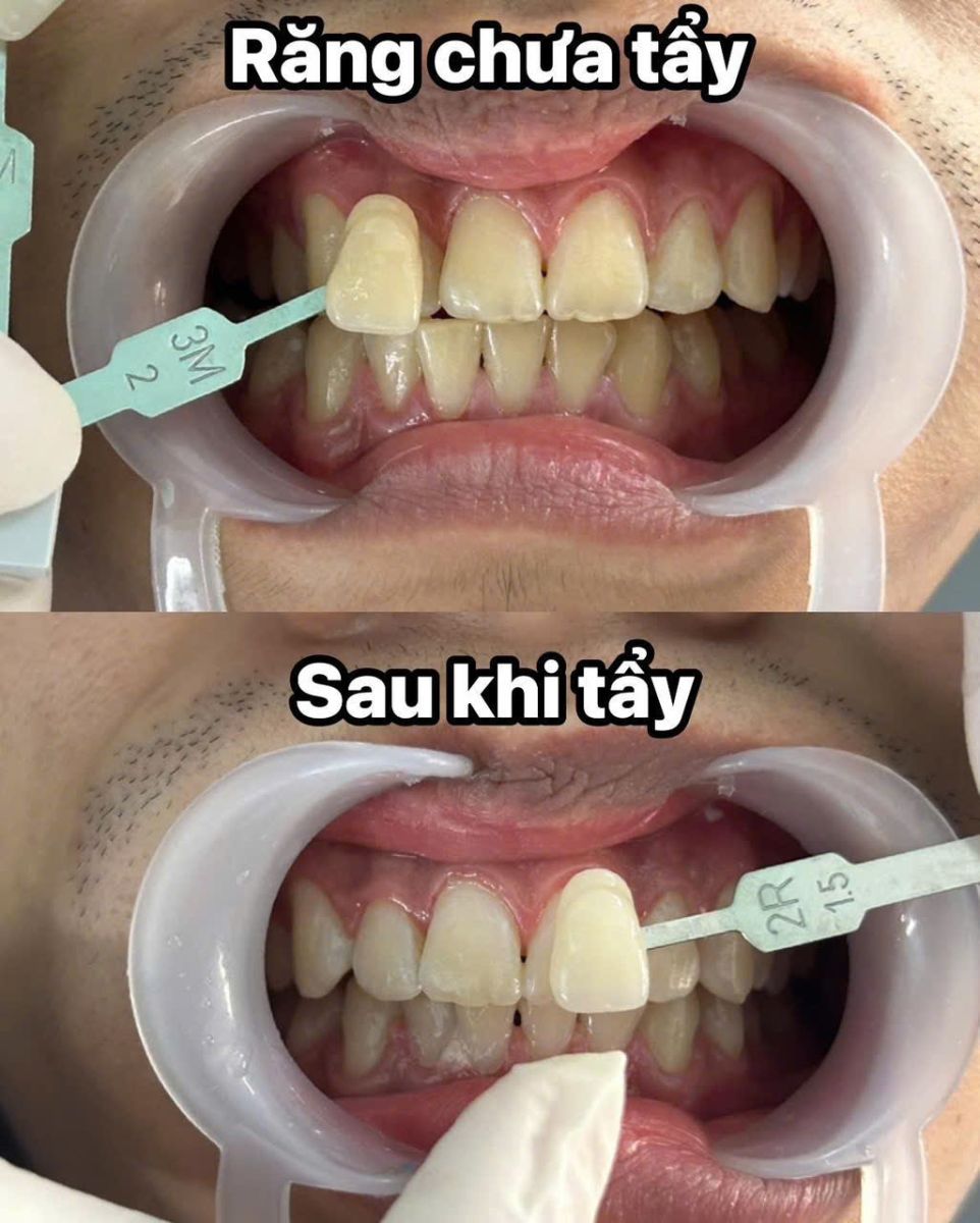 Tẩy trắng răng 