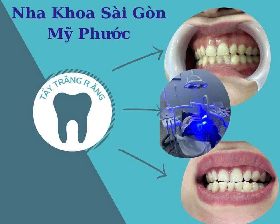 tẩy trắng răng 
